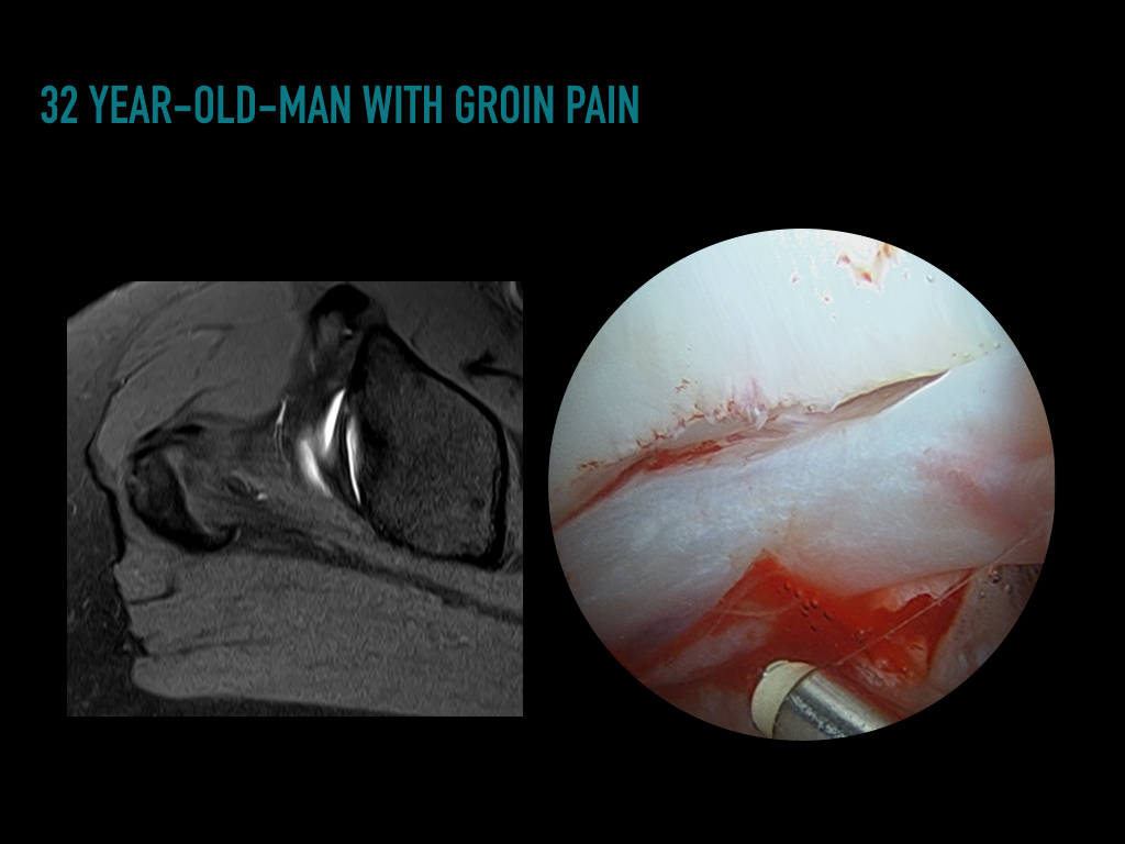 Figure 2 for case Sublabral sulcus